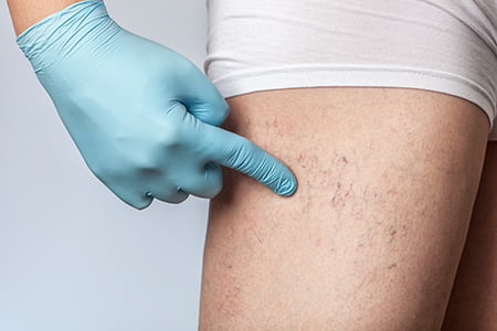 spider-veins-sclerotherapy