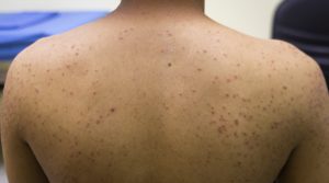 Folliculitis 1