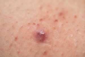 Folliculitis 2