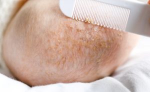 Seborrheic Dermatitis infant