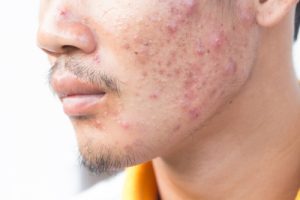 acne-asian-man