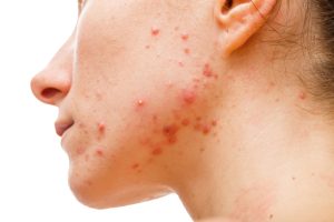 acne-causcasian-woman