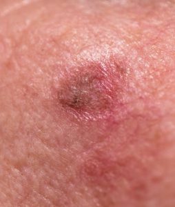 actinic-keratosis-on-cheek