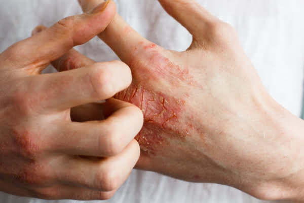 adult-hand-dermatitis