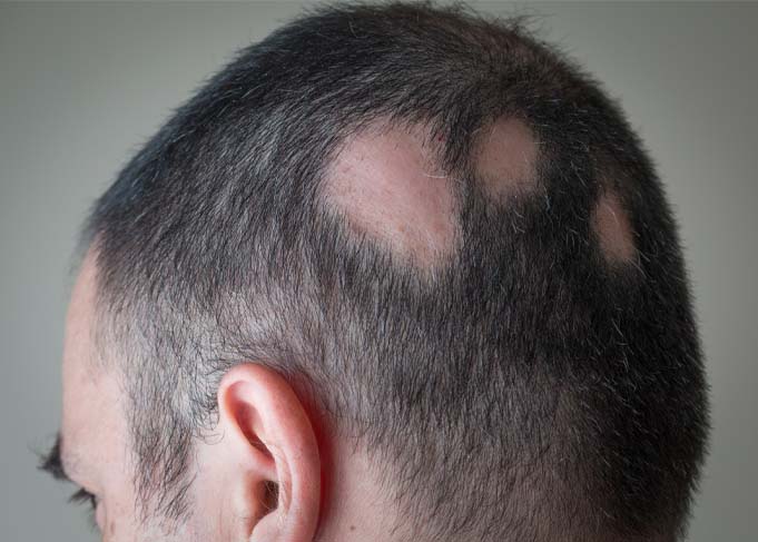 alopecia-areata-man