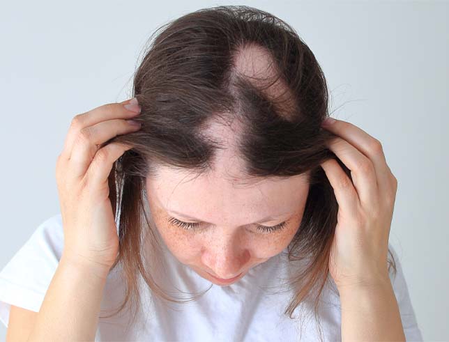 alopecia-areata-woman