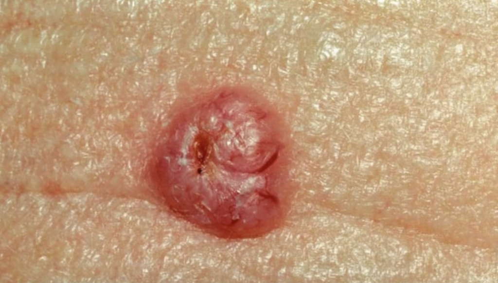 basal cell carcinoma 1
