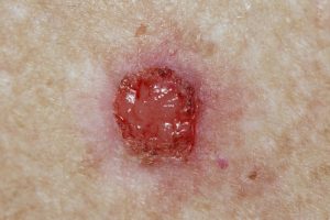 basal cell carcinoma 2