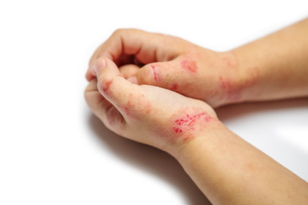 child-hand-dermatitis