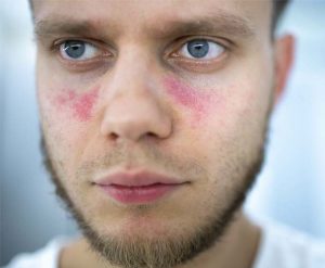 cutaneous-lupus-erythematosus