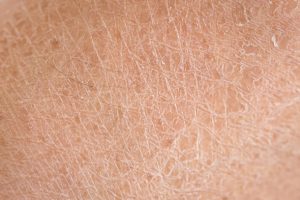 dry-skin-texture