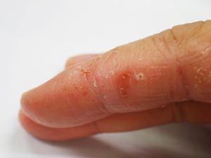 dyshidrotic-eczema-1