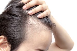 hair loss 1