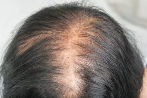 hair loss 2