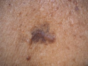 melanoma-1