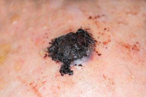 melanoma-2