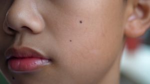 moles-on-young-boys-face