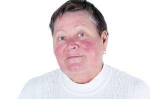 rosacea-1