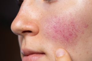 rosacea-2