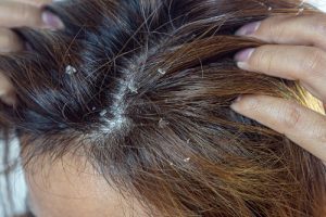 seborrheic dermatitis woman scalp