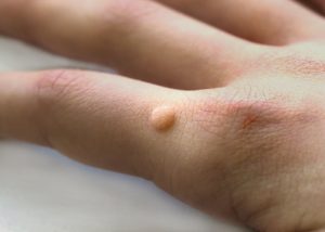 warts-1