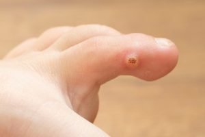 warts-2