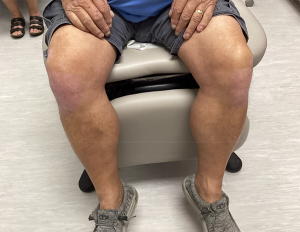 Psoriais Blog knee after