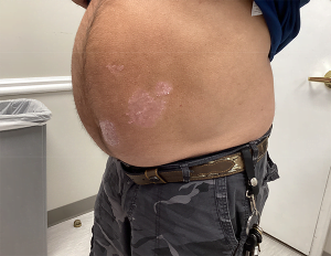 Psoriasis Blog stomach before